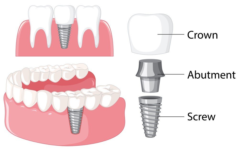 Best Dentist For Dental Implants in Agra