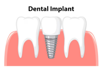 Best Dental Implant Specialist in Awas Vikas Colony