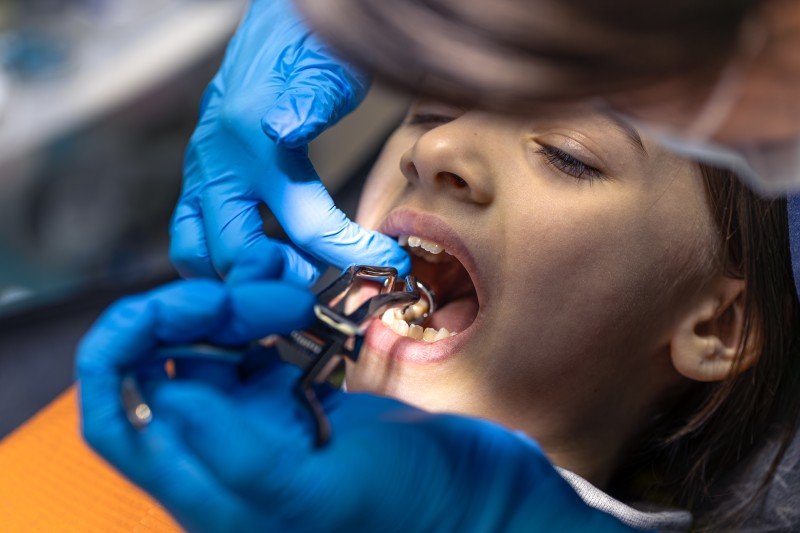 Best Painless Tooth Extractions Treatment in Agra