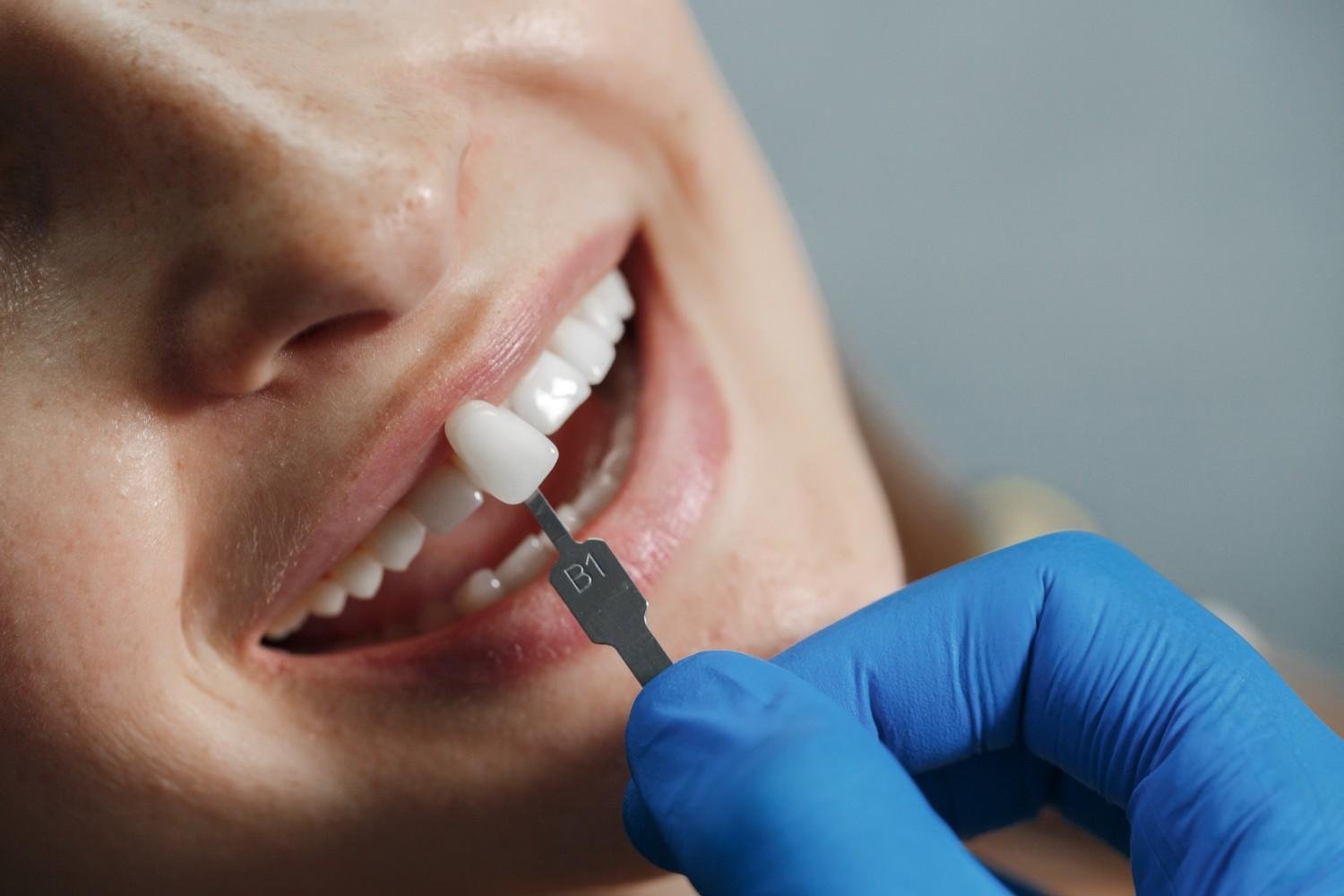 Affordable Dental Implants in Agra