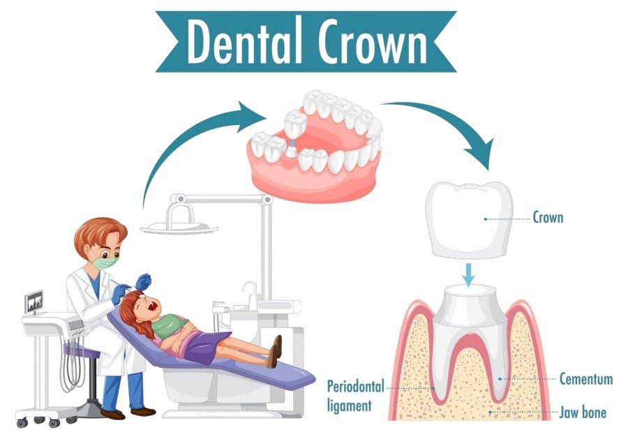 Dental Crown Treatment in Awas Vikas Colony Agra