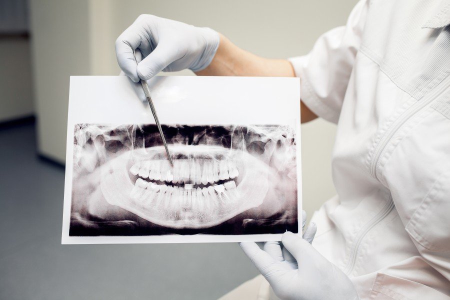 Dentist examining a panoramic dental X-ray for missing teeth treatment